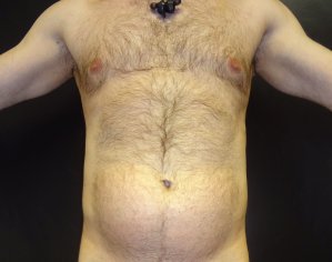 Manhattan liposuction before 16